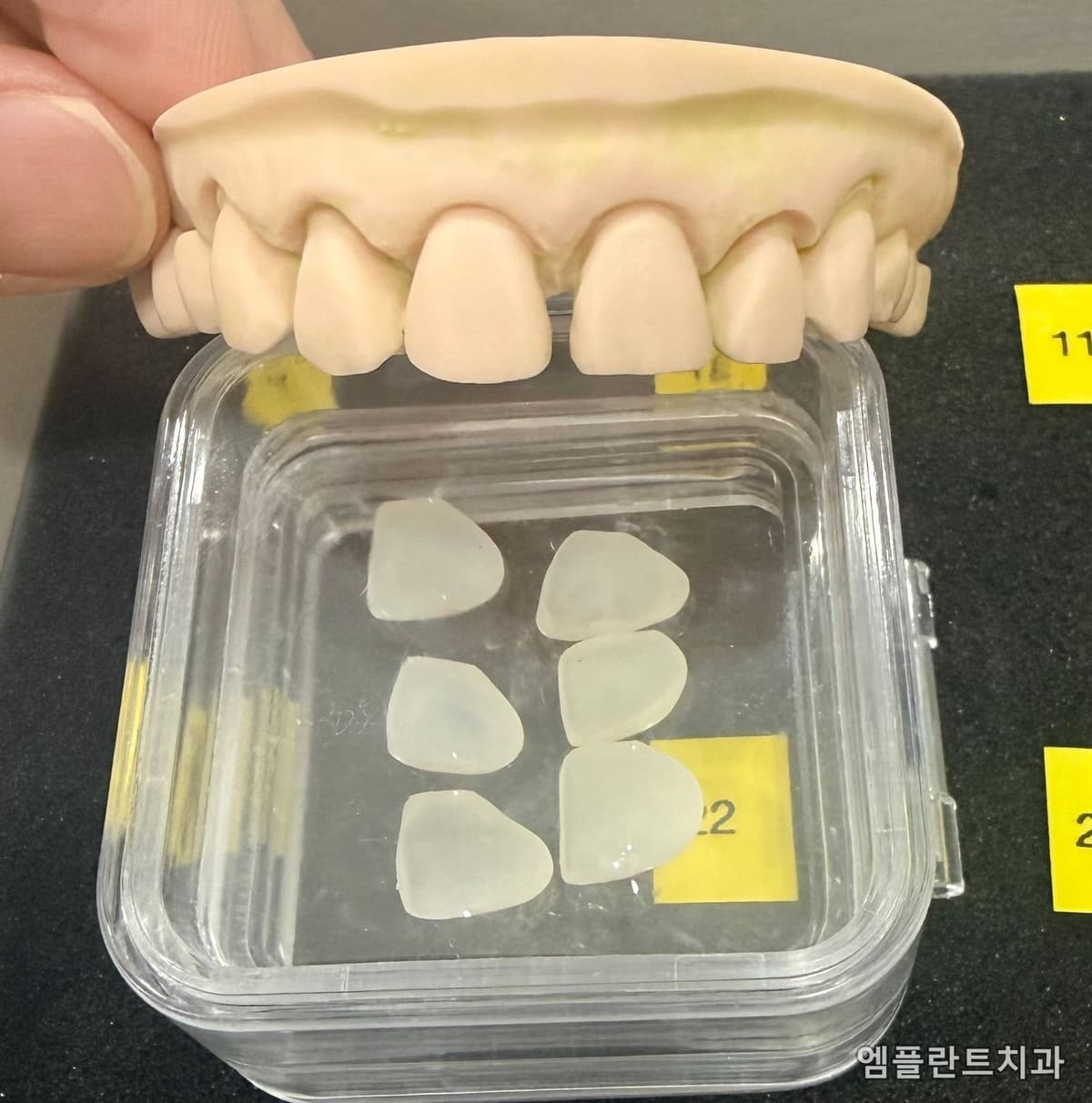 제작이 끝난 라미네이트 세라믹 여섯 조각과 치아 모형 — 얇고 투명한 조각이 케이스에 담겨 있는 모습