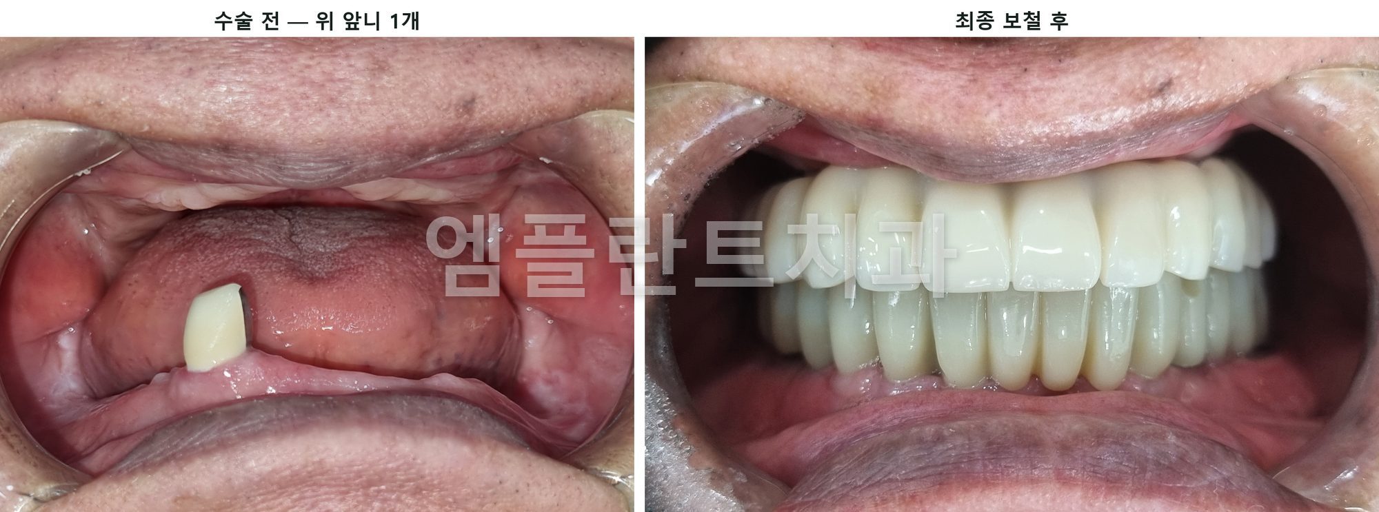왼쪽은 위턱에 앞니 하나만 남은 수술 전 모습, 오른쪽은 위아래 고정식 보철을 마친 모습