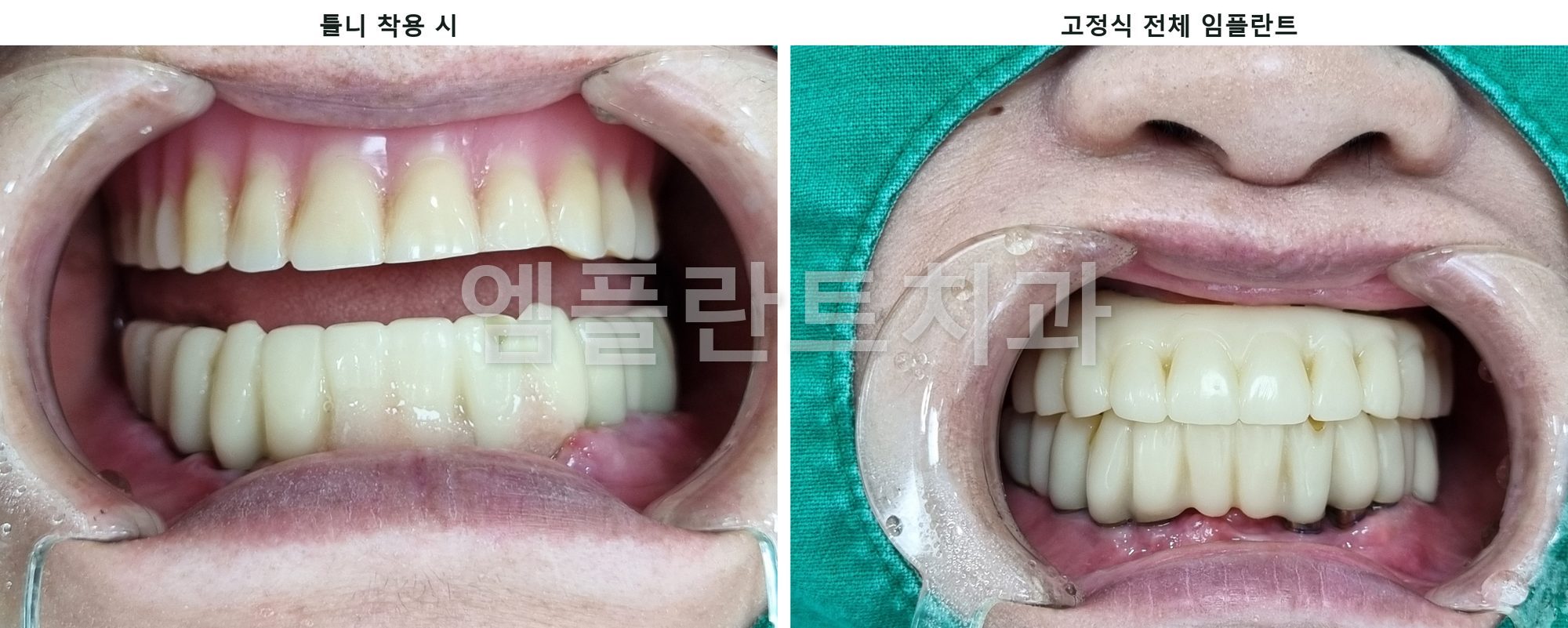왼쪽은 위 틀니를 낀 모습, 오른쪽은 고정식 풀아치 임플란트로 바꾼 모습