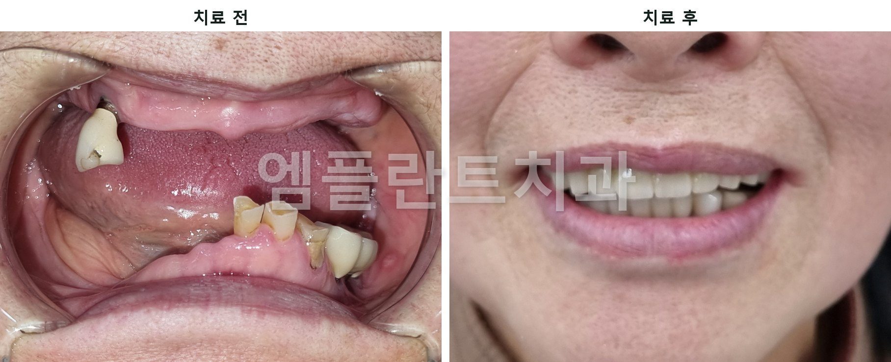 치료 전 치아가 몇 개만 남은 입 안과 치료 후 고정식 치아로 웃는 모습 비교