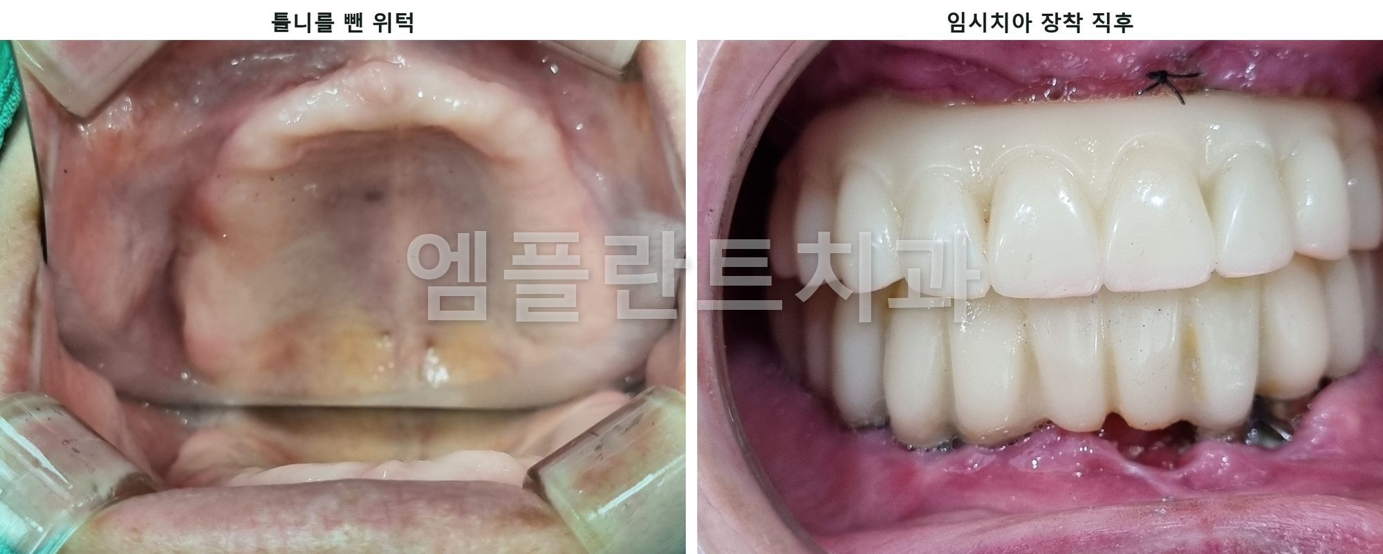 왼쪽은 틀니를 뺀 치아 없는 위턱, 오른쪽은 고정식 임시치아가 연결된 모습