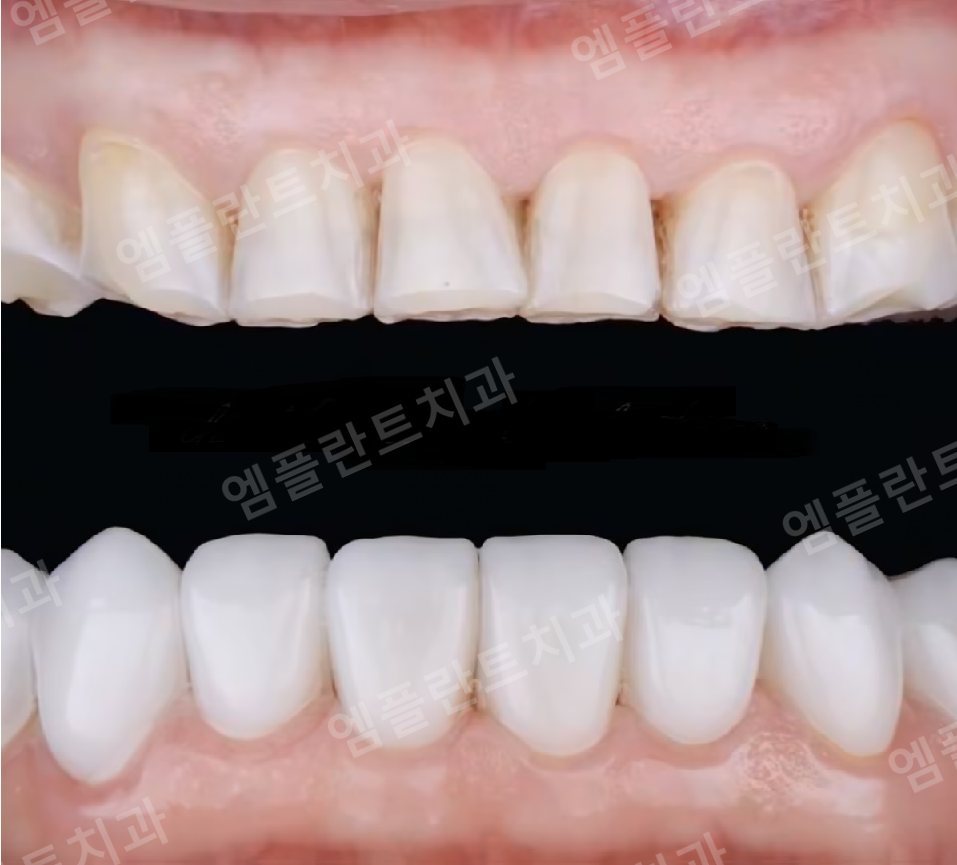 아래쪽 앞니에만 라미네이트를 한 상태 — 위쪽 자연치와 색이 다르게 보입니다